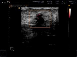 Doppler Ultraschall CA